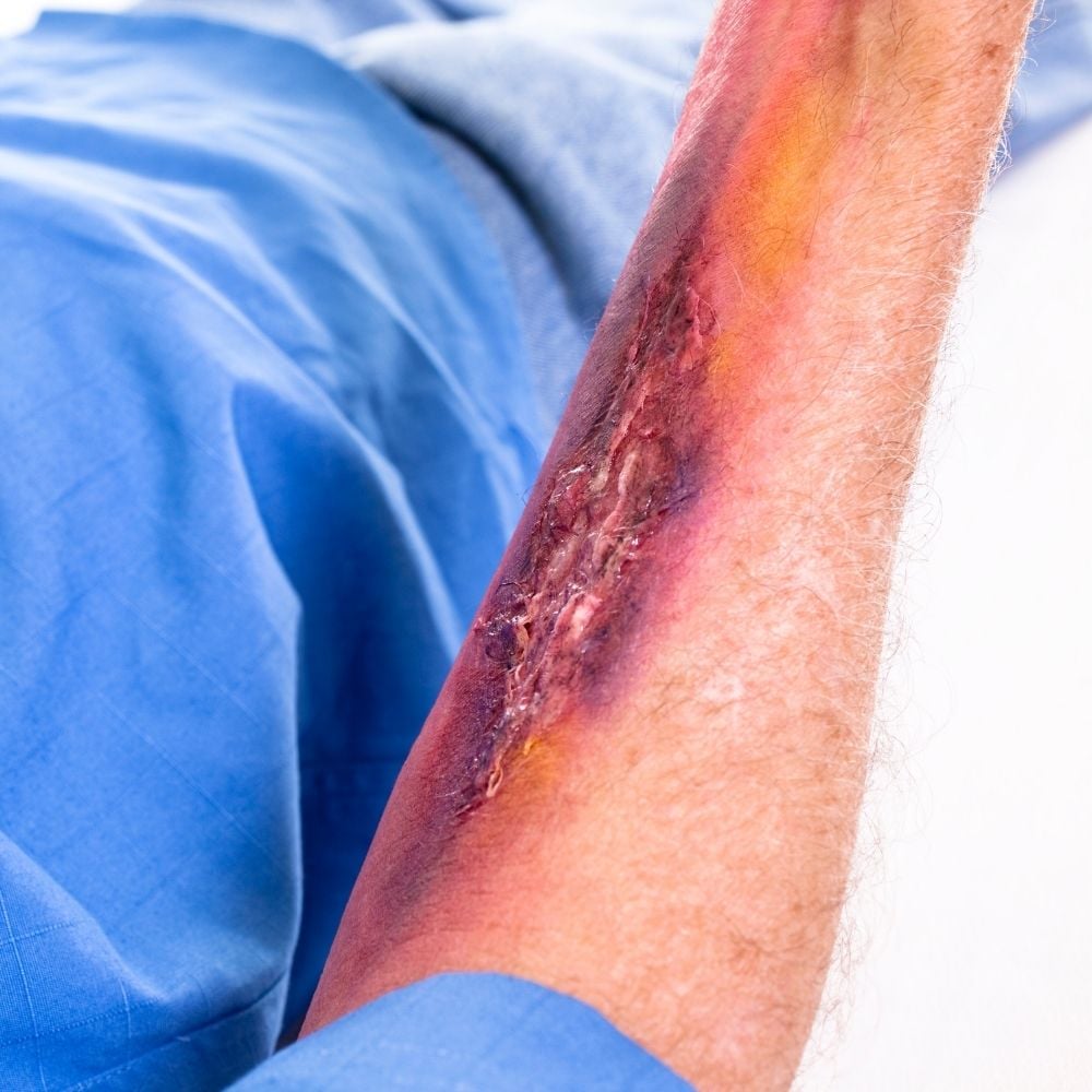 Burn injury